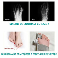 【2 buc】Corector Ortopedic pentru Monturi și Hallux Valgus, cu Buton Rotativ Ajustabil 0-45° – Dispozitiv Medical Fără Durere, Zi și Noapte